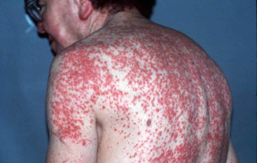 Uitgebreide jeukende rode vlekken en bultjes door een allergie op een antibioticum (amoxicilline)