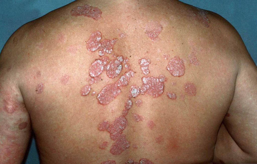 Rood schilferende plakkaten op de rug passend bij psoriasis