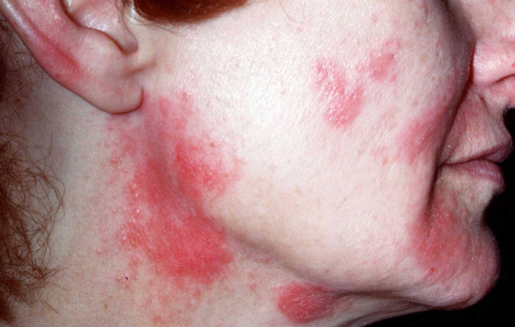 Rode jeukende vlekken in het gezicht door een contactallergie op een conserveermiddel in een antirimpelcrème