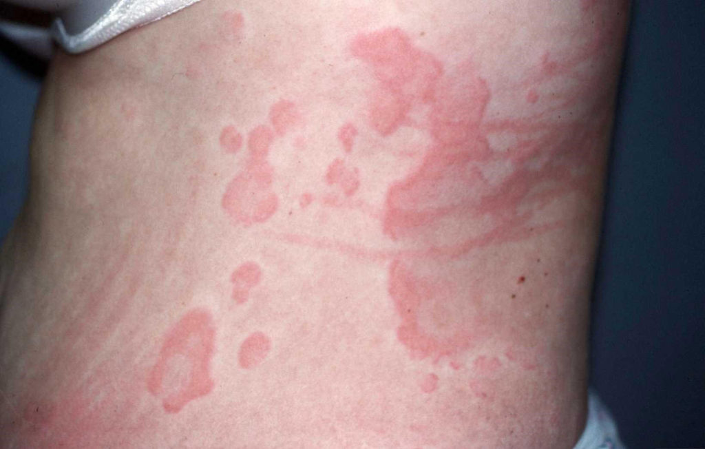 Ringvormige jeukende rode vlekken en plakkaten die wordt gezien bij netelroos (urticaria). De oorzaak hiervoor was een allergie op garnalen.