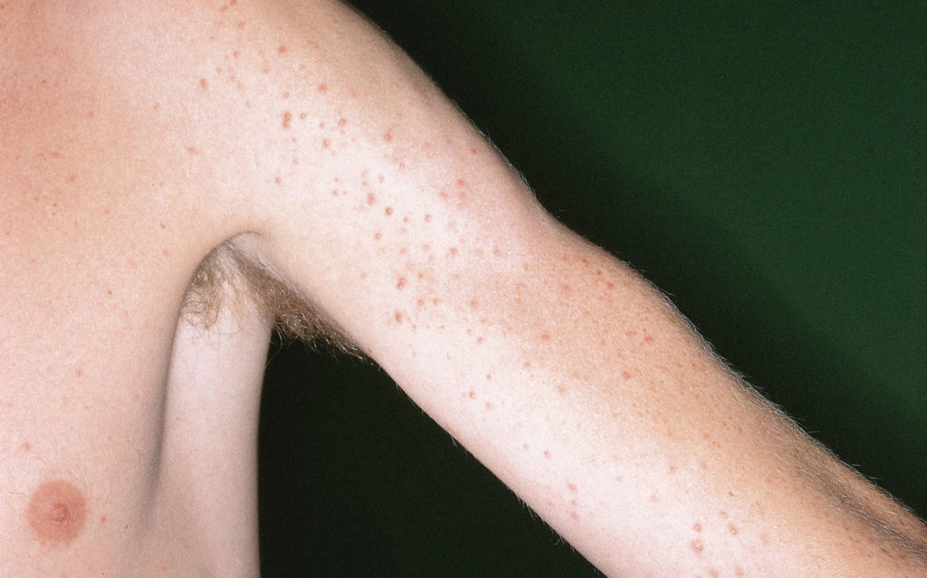 Mallorca acne op de linker bovenarm