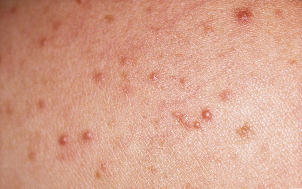 Detail foto van Mallorca acne: Monomorf beeld, behalve een enkele pustel alleen maar rode bultjes te zien