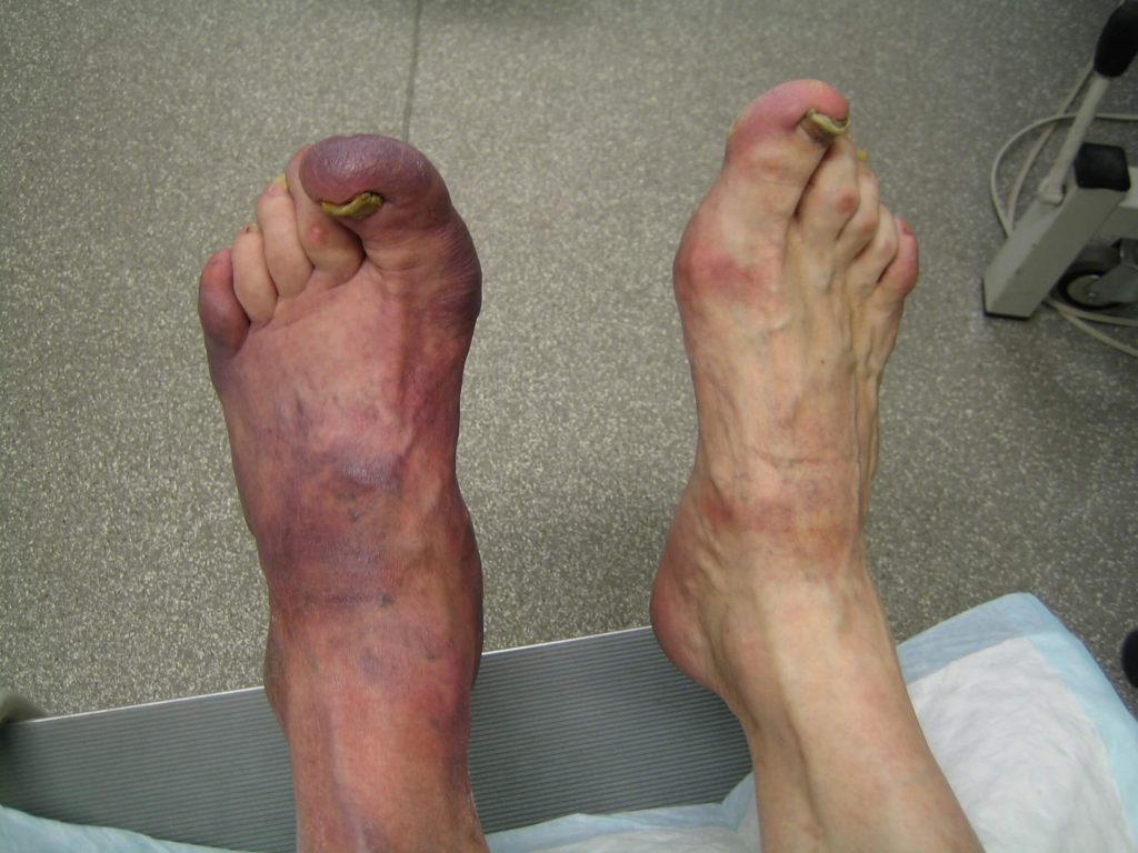 ACA kan beginnen als een pijnloze paarsrode verkleuring van één voet