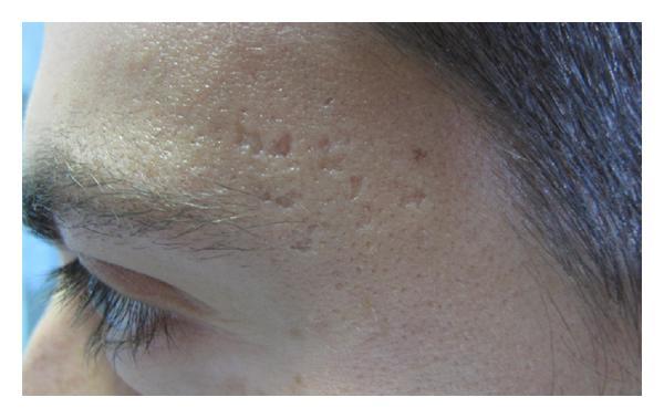 Boxcarlittekens na acne