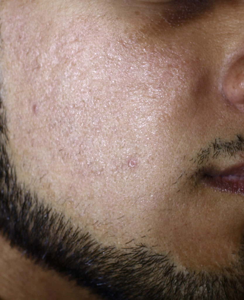 Acne littekens, na 2 behandelingen met de gefractioneerde CO2 laser