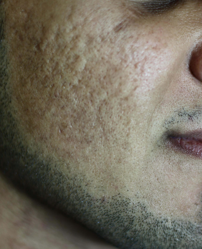 Acne littekens, vóór behandeling met de gefractioneerde CO2 laser
