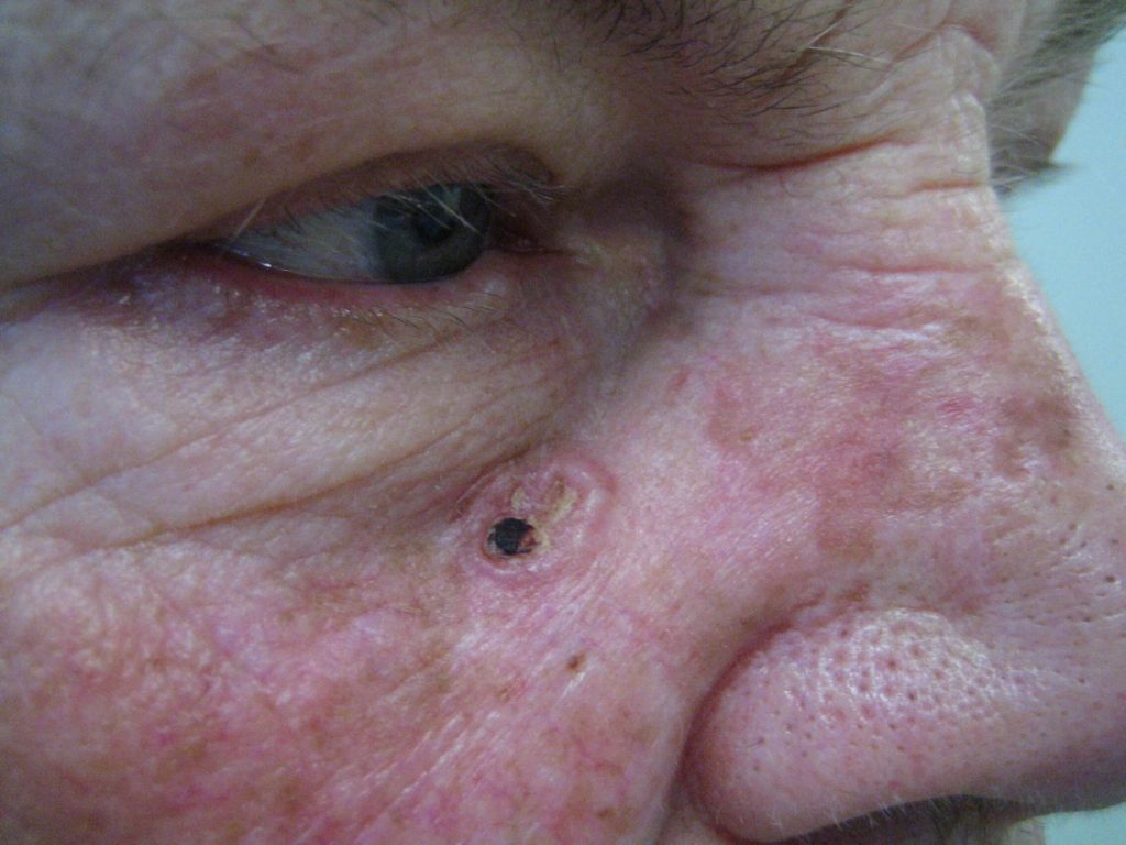 Klassiek beeld van een BCC, een niet genezend zweertje in het gezicht van een 54 jarige man