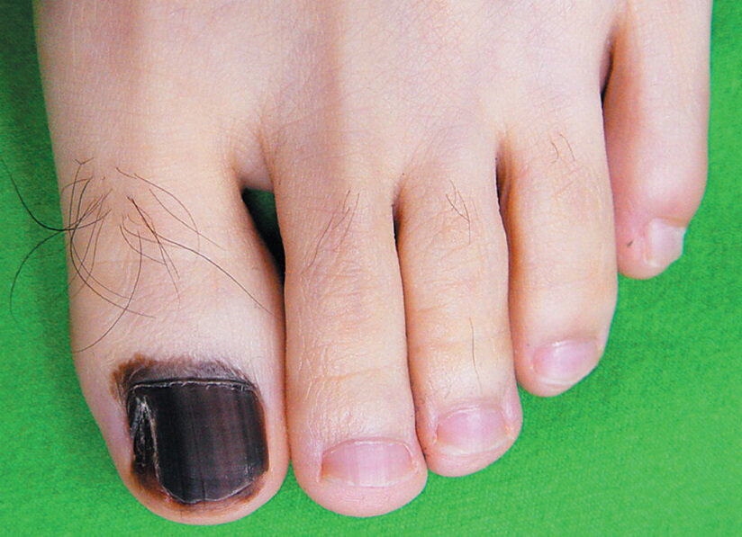 Melanoom van de nagel (subunguaal melanoom)
